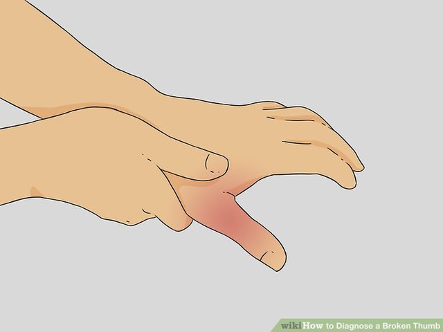 Broke my thumb