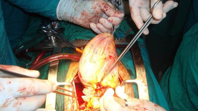 Transplante de corazón