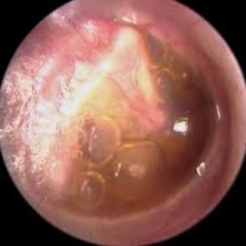 Primeros tratamientos ante infecciones del oido