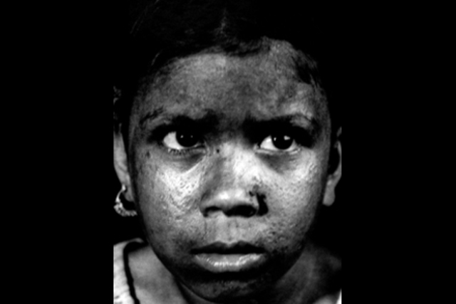 Erradicación mundial de la viruela