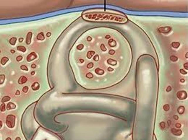 Inicio de la cirugía microscópica en otología