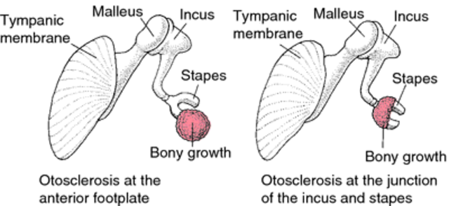 Primer implante en la otología