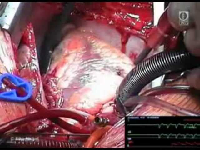 Desfibrilación Directa