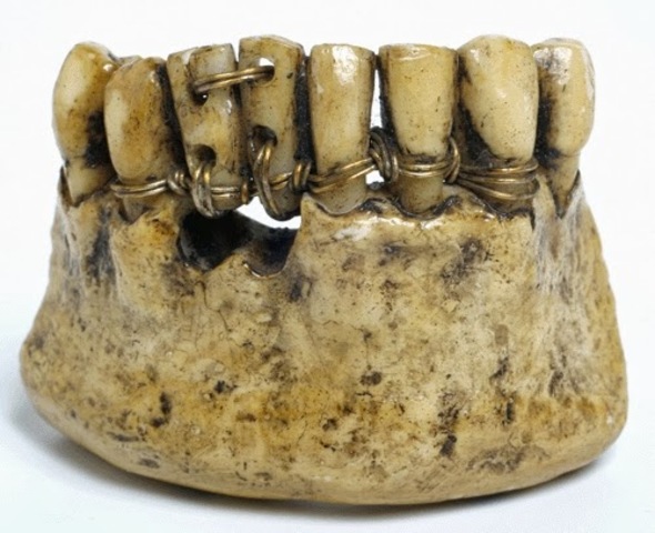 Antigüedad Implantes Dentales