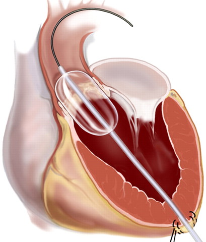 Primera Valvuloplastia Mitral