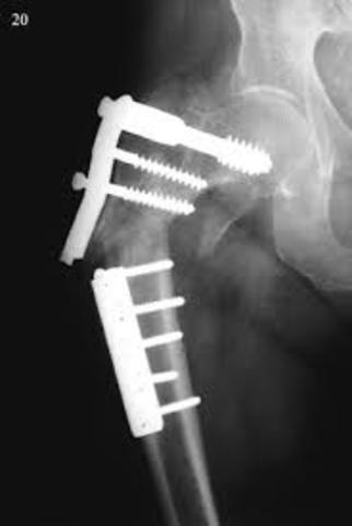 Placas Para  La Reparación De Fracturas De Huesos