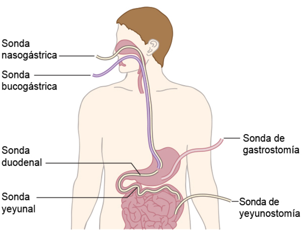 Nutrición por el esófago