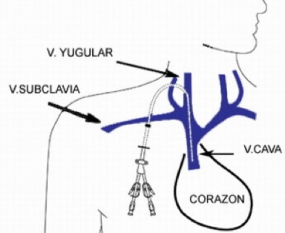 Whipple, Colman y Madden
