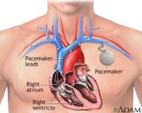 Cardiac Pacemaker