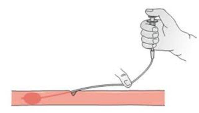 Balloon Embolectomy Catheter