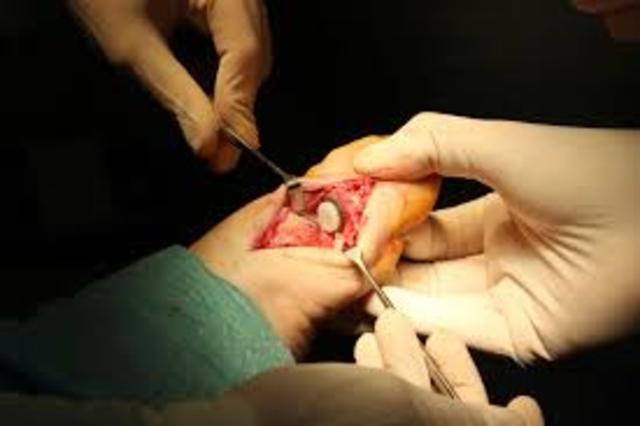 Aleaciones Base Cobalto Para Cirugía Ortopédica