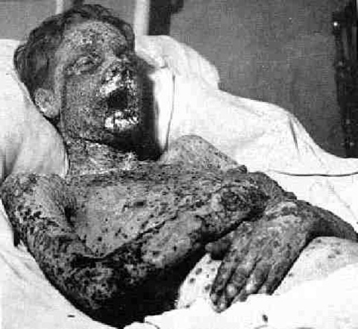 130,000 whites and Indians died from smallpox