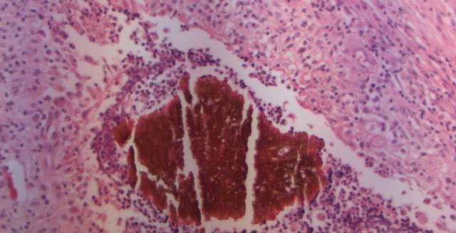 Se acuña el termino ''Micetoma''.