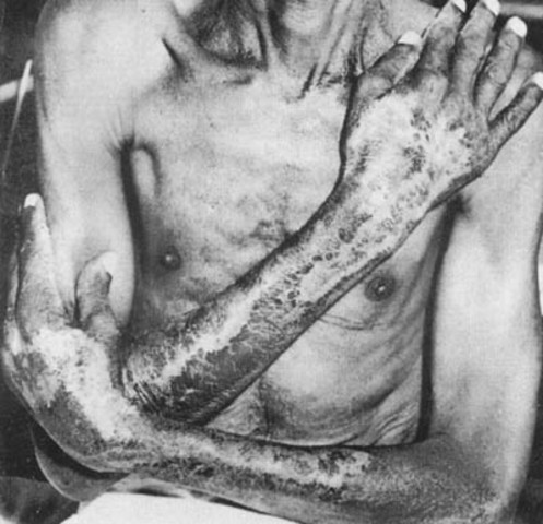 Primer Brote importante de pelagra en EE.UU.