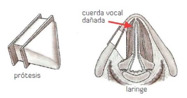 Prótesis de titanio