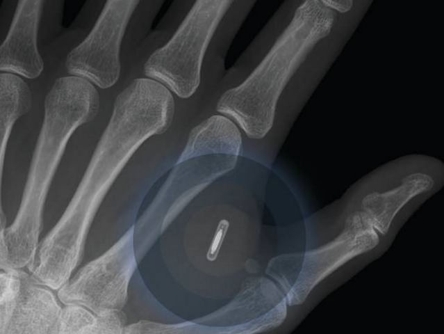 Telefonía móvil "implantada"