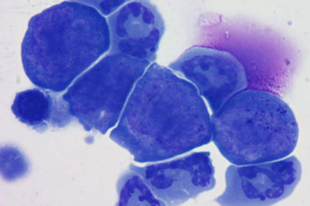 Molécula contra el cáncer