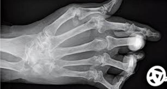 Galileo y la enfermedad