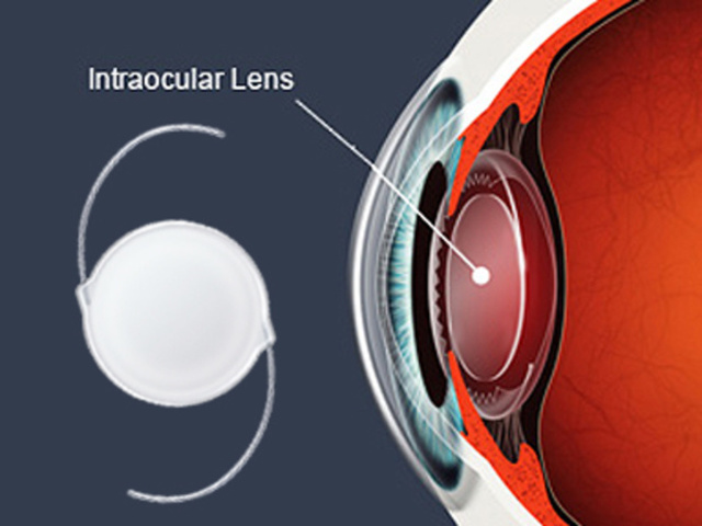 The First Intraocular Lens is used