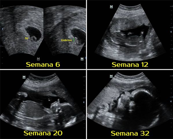 Intrauterina