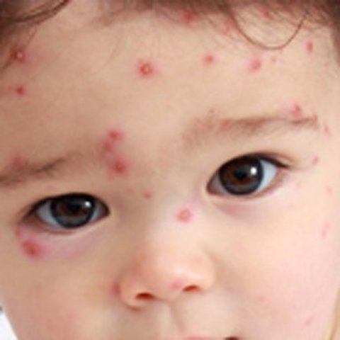 Se contagio de Varicela