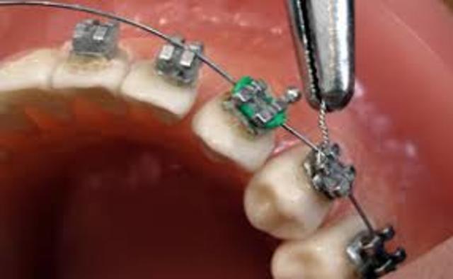 Brackets,Pierre Fauchard