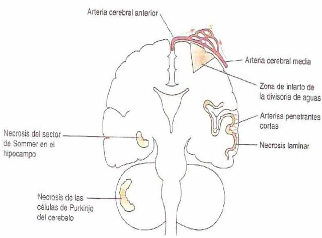 Infarto en divisoria de aguas