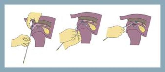 Artificial Insemination