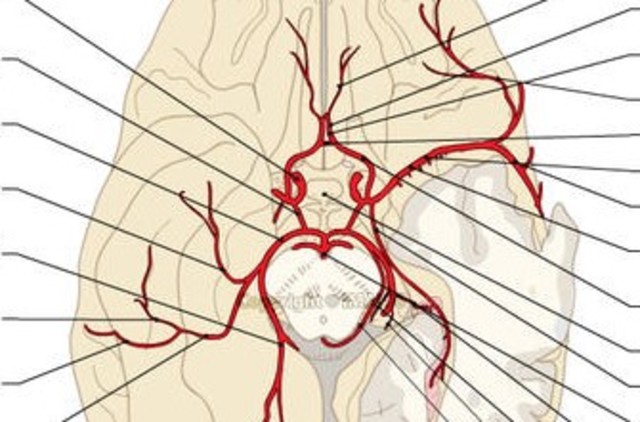 Infarto en divisoria de aguas