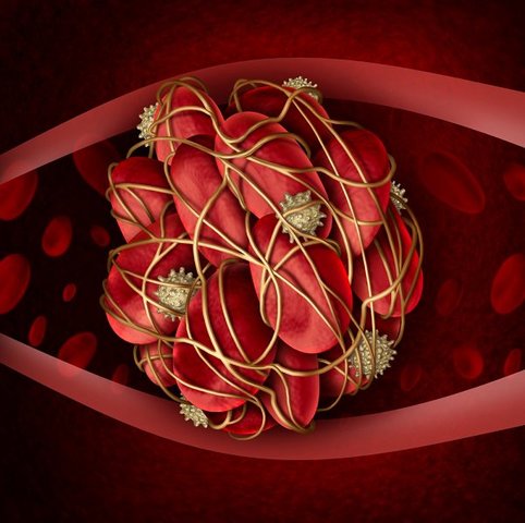 Hipoperfusión posisquémica