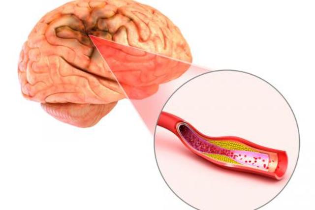 Tratamiento de Isquemia Global