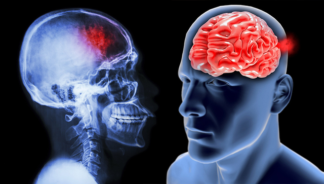 Mecanismos de Lesion