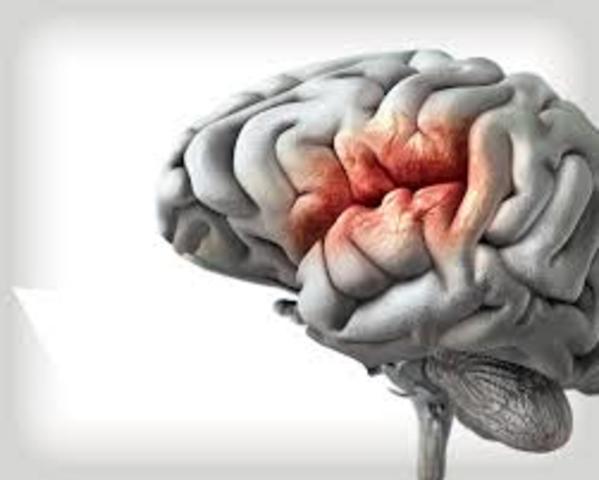 EVENTO VASCULAR CEREBRAL