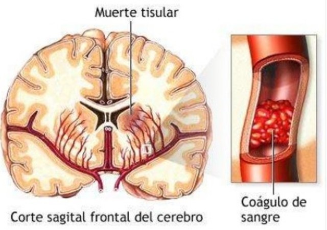Infarto en divisoria de aguas