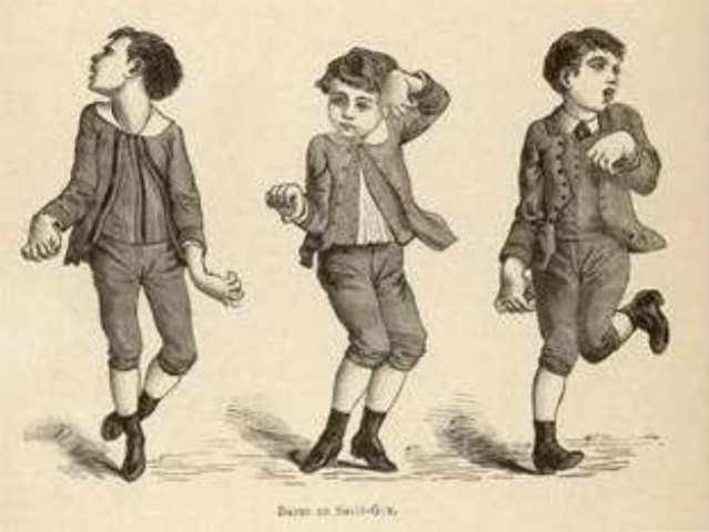 Lesiones provocadas por aminoácidos excitatorios.