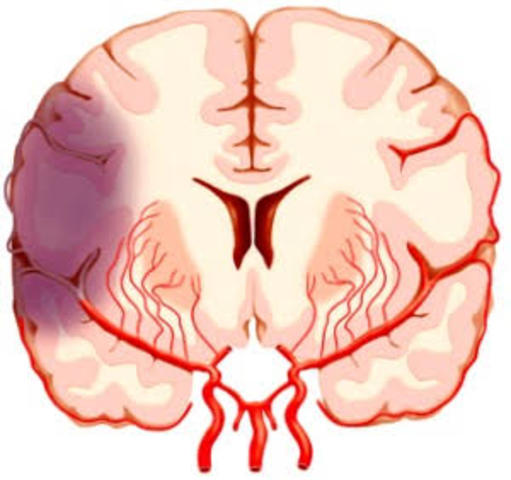 Lesiones hipóxicas e isquemicas