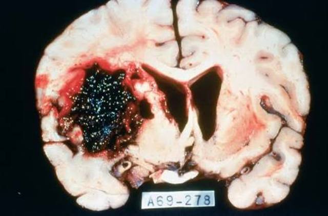 Isquemia global grave