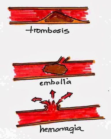 Aterotrombosis o hemorragia