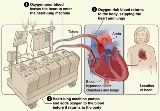maquina de circulación extracorporea