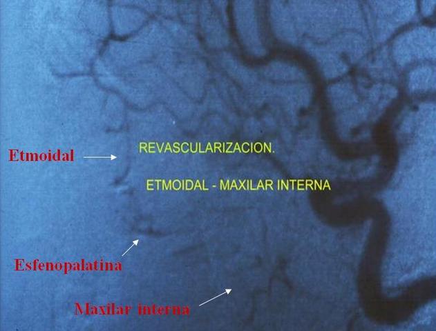 Taponamiento nasal