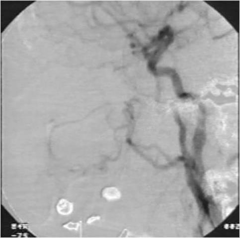 Arteriografía y embolización.