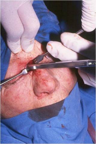Ligadura de arterias etmoidales