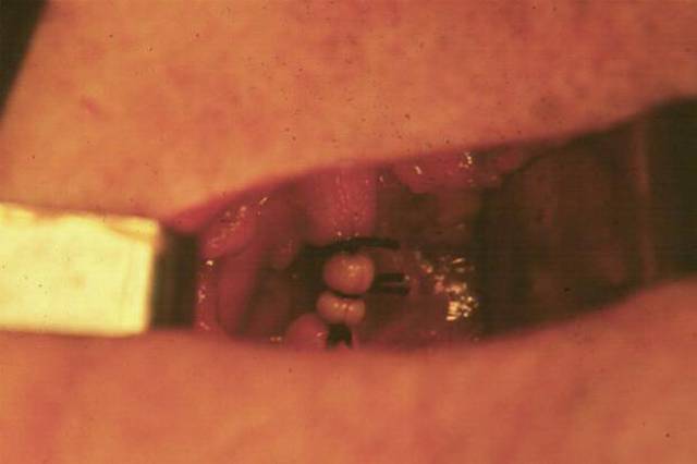 Ligadura de la arteria carotida externa