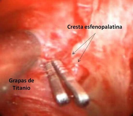 Ligadura de arteria esfenopalatina.
