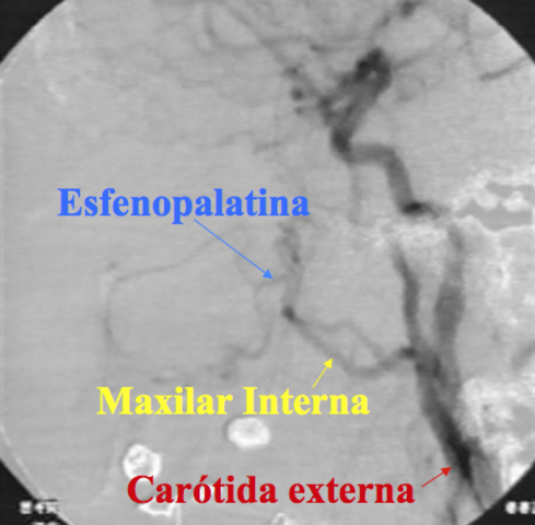 Ligadura arterial
