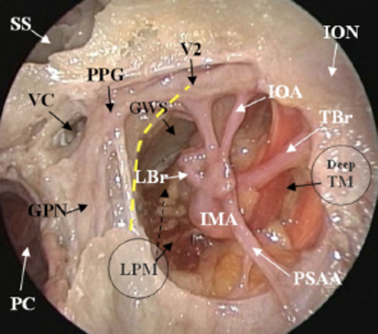 Ligadura de la arteria maxilar interna.