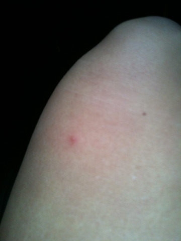 Bartonville female - lethargic, leg cramps, congeation, headache, blisters on legs - burn smell every where