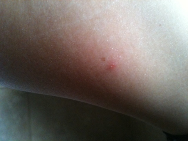 Bartonville female - blisters on legs and hands; pop and ooze clear