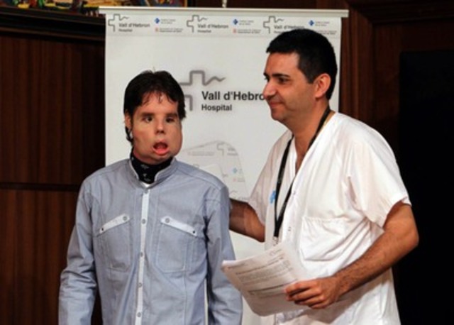 Trasplante total de cara.