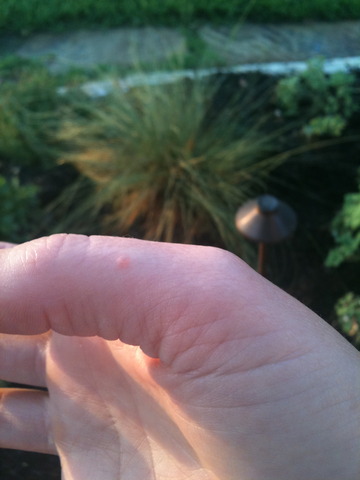 Bartonville female - extremeley tired, achy, eyes are swollen